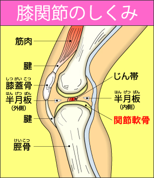 画像：変形性膝関節症